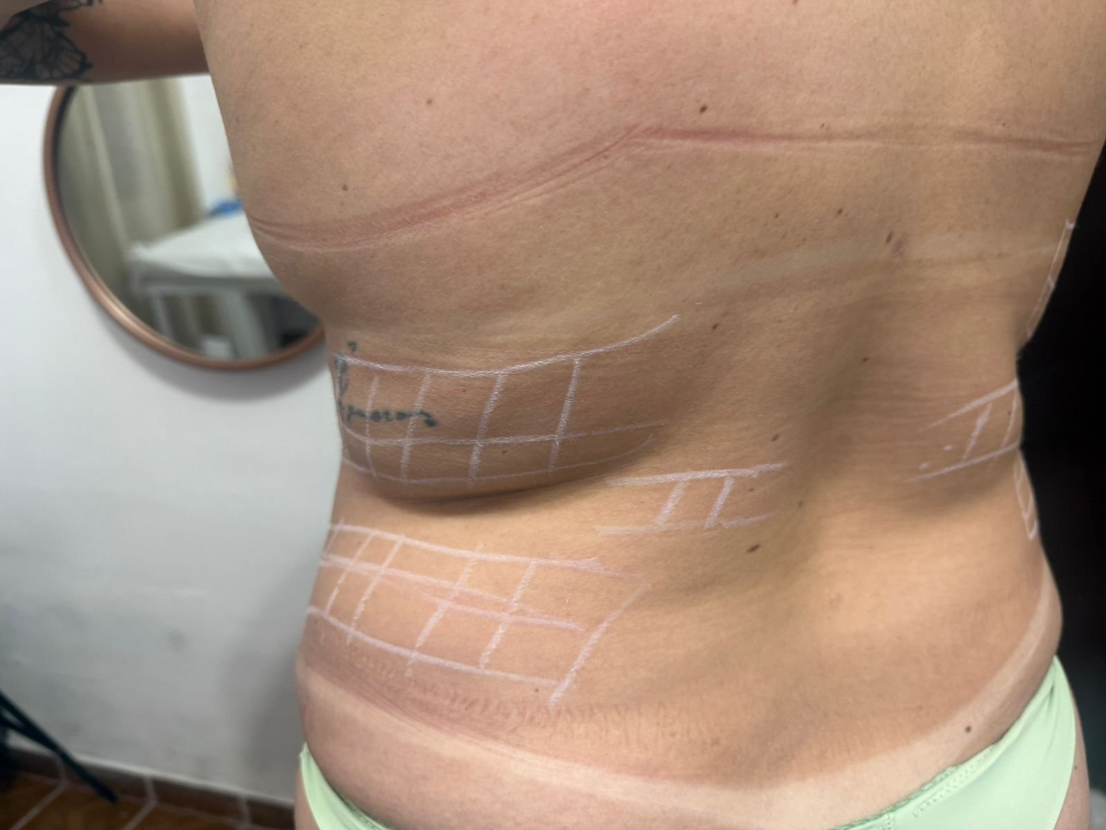 Exemplo de resultado: tratamento corporal com lipoquímico e modeladora na Ilumina Skincare